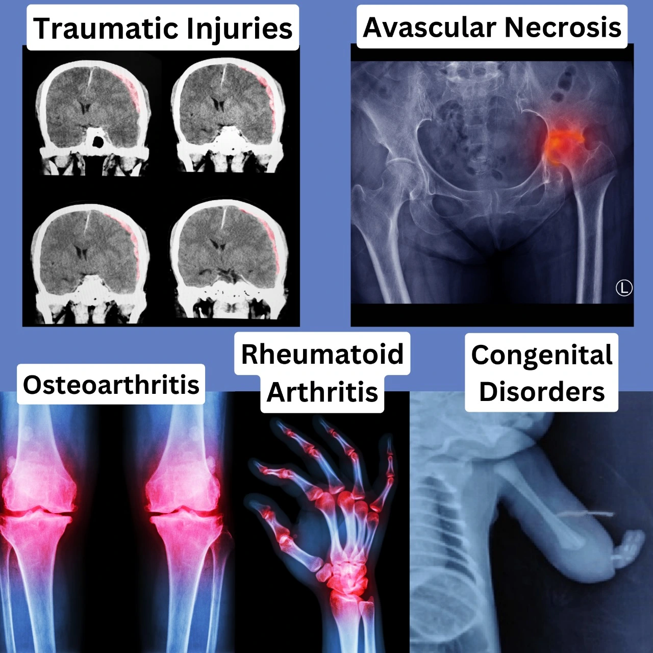 Joint pain 