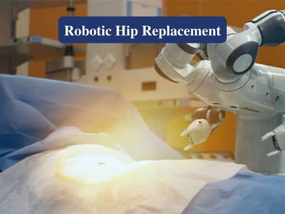 Robotic Hip Replacement