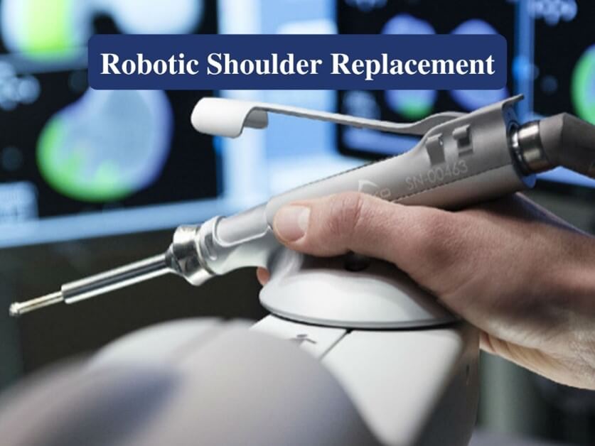 Robotic Shoulder Replacement