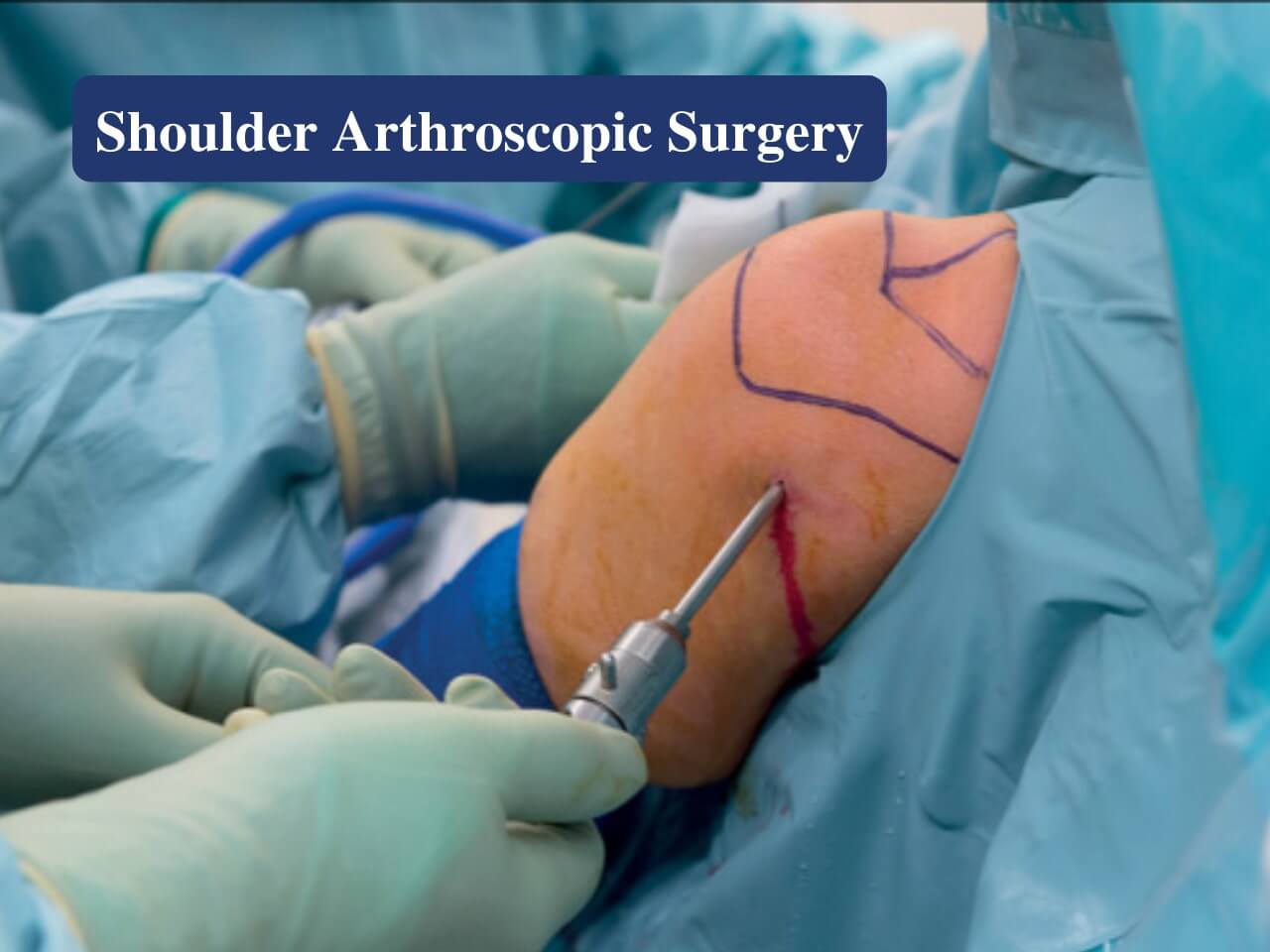 Shoulder arthroscopy surgery