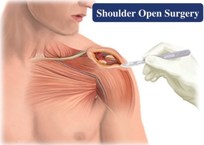 Shoulder open surgery