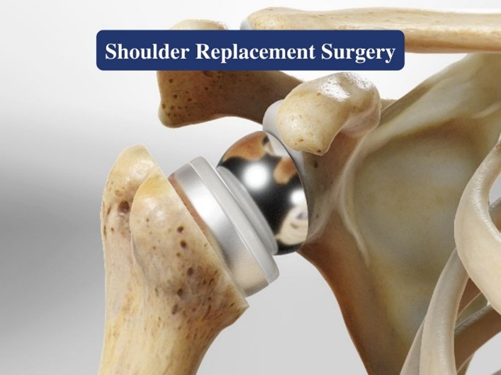 Shoulder replacement surgery