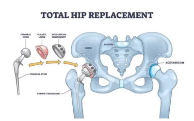 Post-Surgery Do’s and Don’ts for Total Hip Replacement