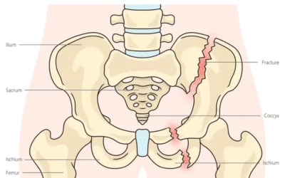 Role of Rehabilitation After Pelvic and Acetabular Surgery