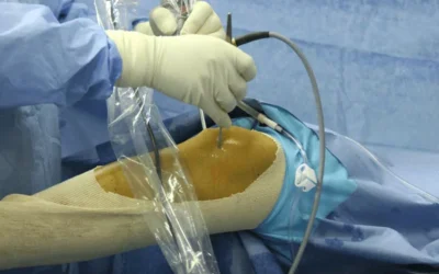 Why Arthroscopy is Revolutionizing Joint Surgery in 2025?