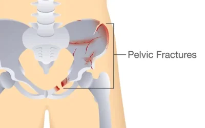 Pelvic Fractures: Symptoms, Causes and Treatments
