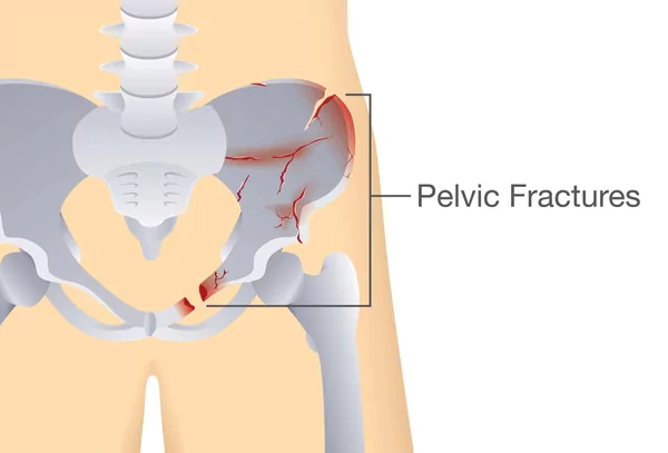 Pelvic Fractures Pelvic Fractures