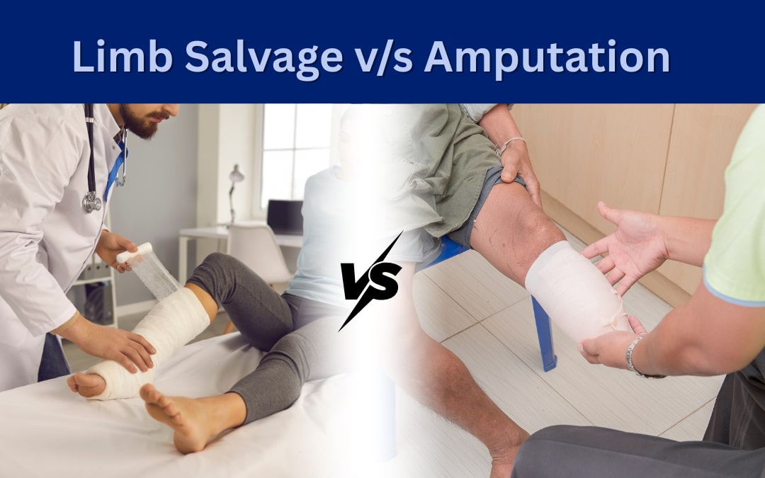 Limb Salvage vs Amputation Limb Salvage vs Amputation
