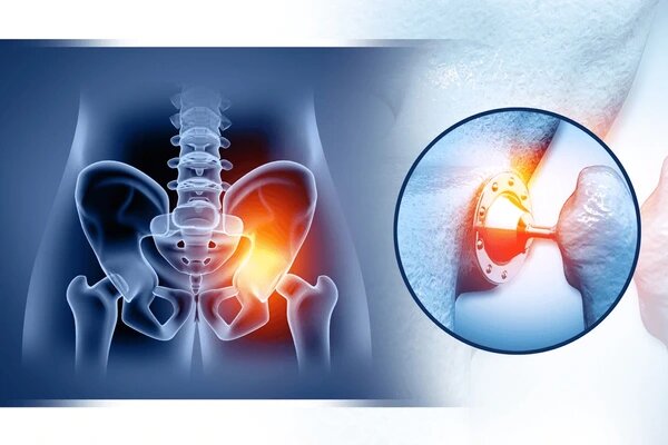 Dual Mobility Hip Implants