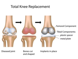 Total-Knee-replacement