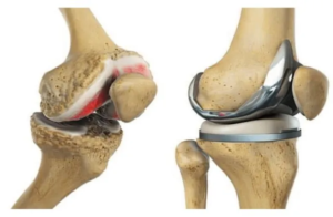 Total Knee Replacement