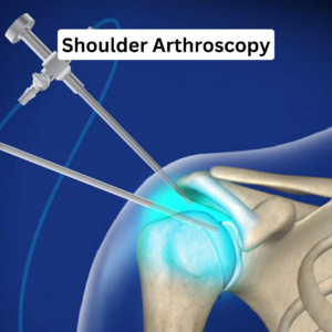Shoulder Arthroscopy