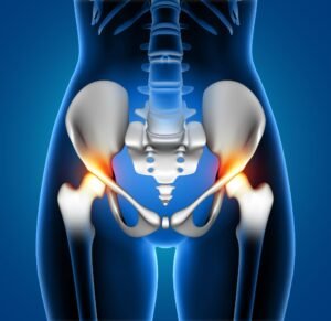 AVN Of Hip