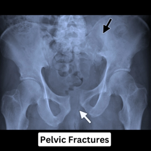 Pelvic Fracture