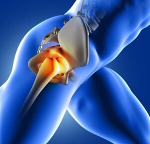 AVN Of Hip
