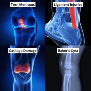 Knee Replacement